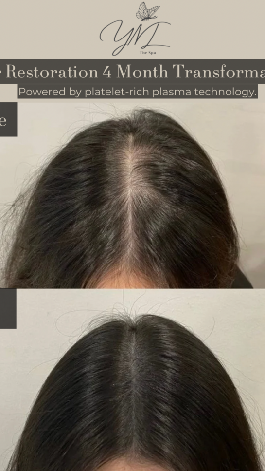 Hair prp restoration